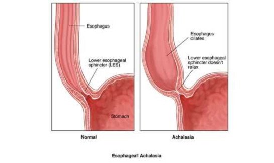 Achalasia-treatment-in-Delhi
