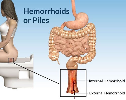 piles-treatment-in-delhi