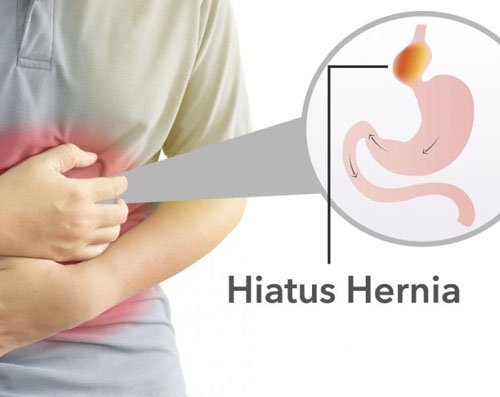 hiatal-hernia-treatment-in-delhi