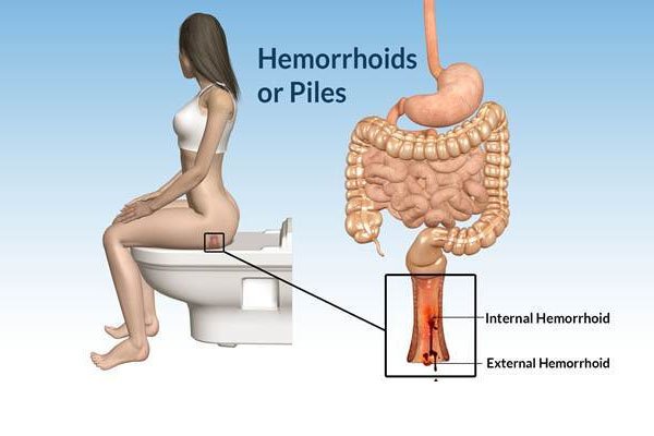 Piles-treatment-in-Delhi