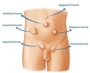 hernia-treatment-in-delhi