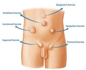 hernia-treatment-in-delhi