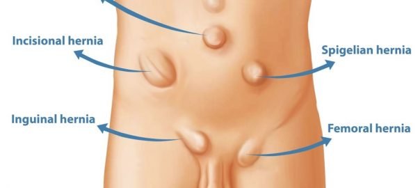hernia-treatment-in-delhi