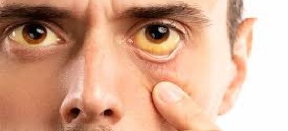 obstructive-jaundice-treatment-in-delhi